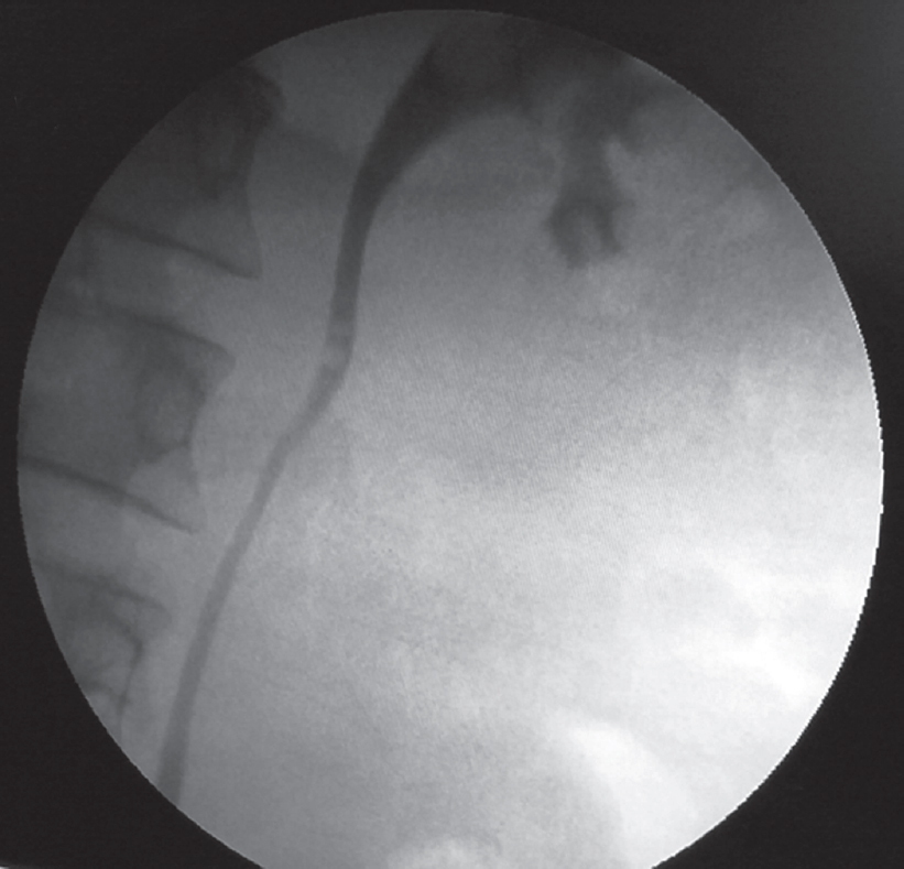 Bilateral retrograde pyelography leading to anuria The National