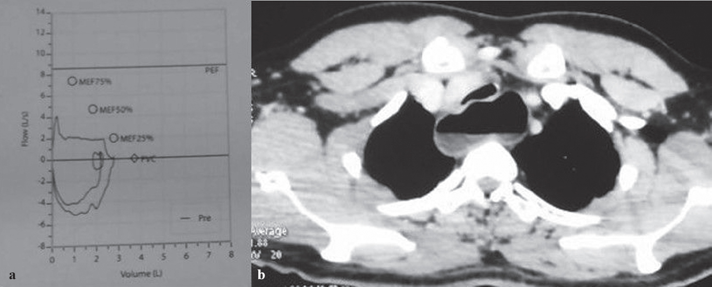 Achalasia cardia presenting with tracheal compression - The National Medical  Journal of India