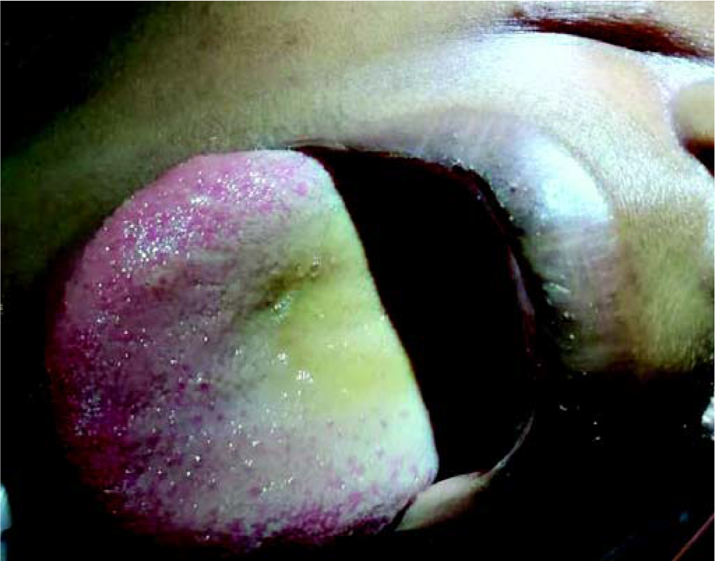 Paraquat tongue presents as an acute painful central ulceration of the dorsum of the tongue on day 2 or 3 of paraquat poisoning