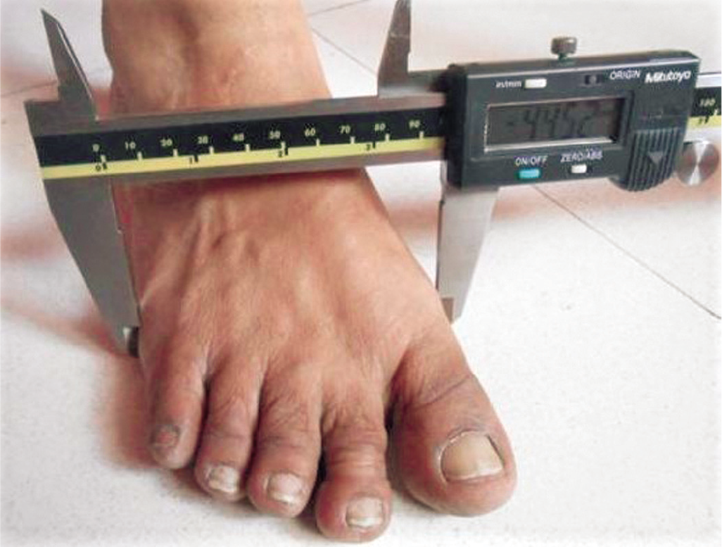 Foot breadth measurement