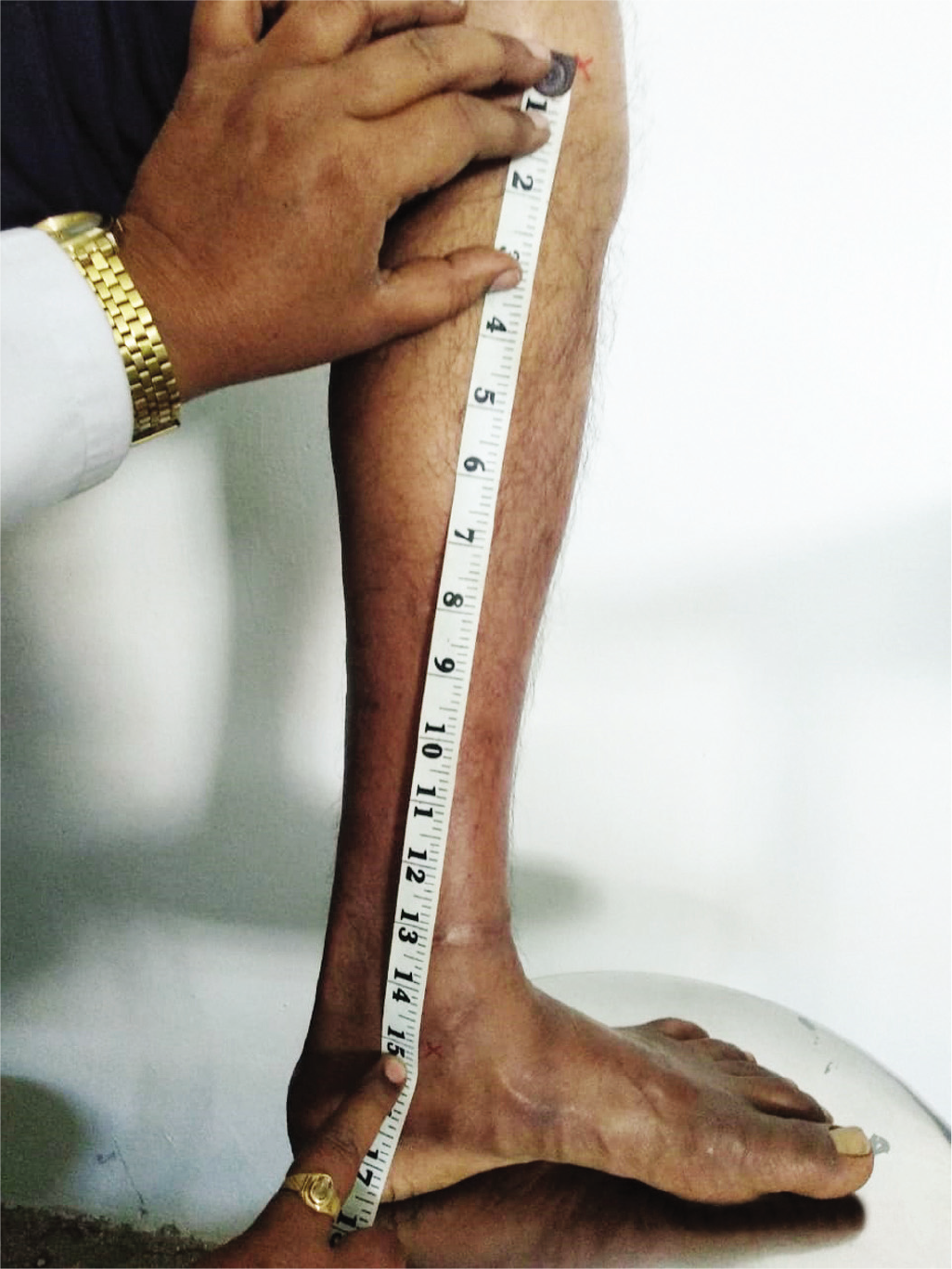 Tibial length measurement