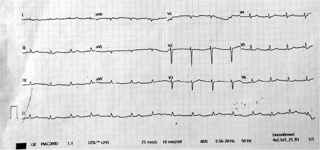 Twelve-lead electrocardiogram showing low voltage complexes in limb leads as wells as precordial leads suggestive of pericardial effusion