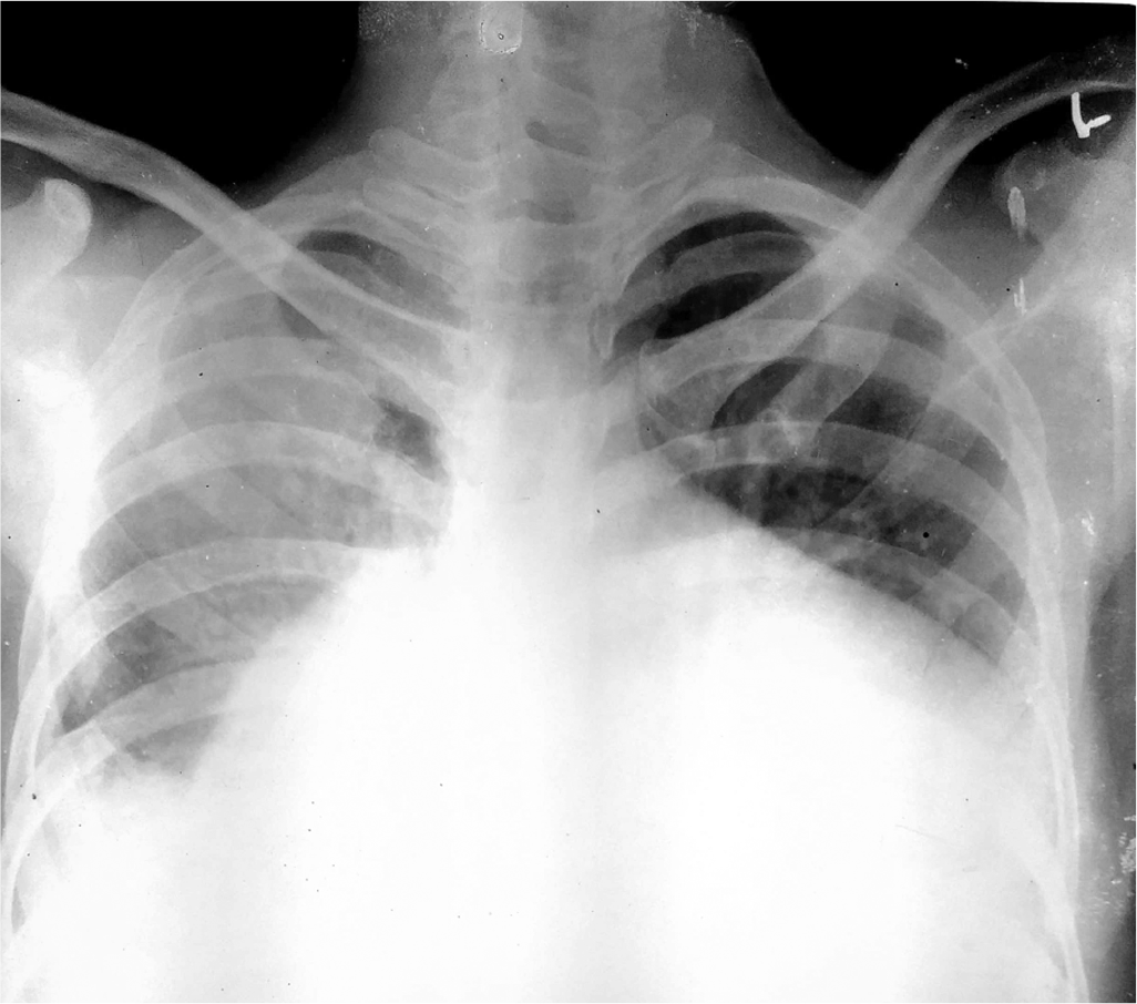 Chest X-ray posteroanterior view showing massive cardiomegaly