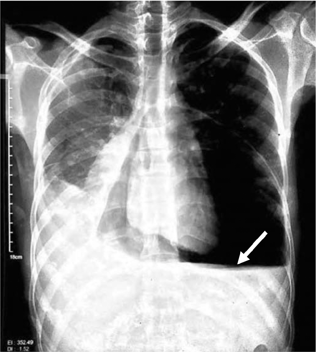 Chest X-ray posteroanterior view showing cardiomegaly secondary to massive hydropneumopericardium with air fluid interface in pericardial space (arrow)