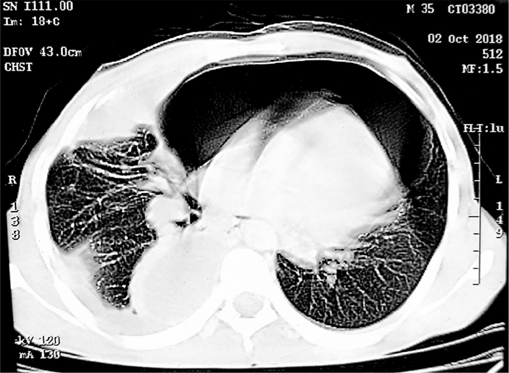 Axial slice of contrast-enhanced computed tomography thorax of the same patient showing hydropneumopericardium