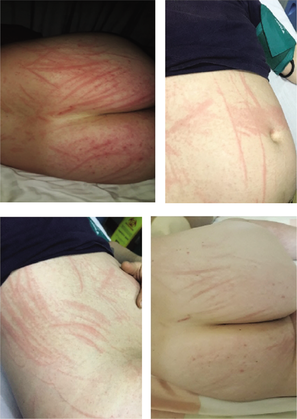 Rash on day 1 (top right), on day 3 (top left and bottom right), fading rash on day 5 (bottom left)