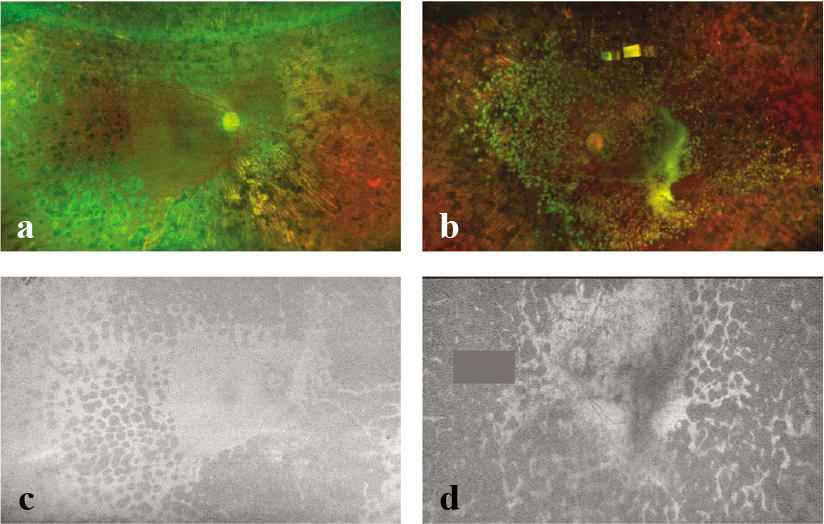 Optos ultra-wide-field pseudocolour images of the right and left eyes of patient 1 with proliferative diabetic retinopathy with asteroid hyalosis. On fundus autofluorescence, the posterior pole of the left eye is visible