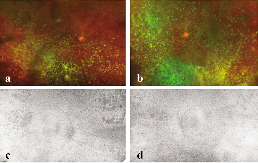 Optos ultra-wide-field pseudocolour images of the right and left eyes of patient 2 with proliferative diabetic retinopathy with asteroid hyalosis. On fundus autofluorescence, the posterior poles of both eyes are visible. Patient 2 was advised additional laser photocoagulation in both eyes