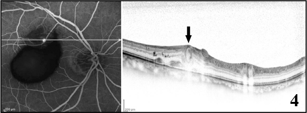 Simultaneous fundus fluorescein angiography and optical coherence tomography images showing the cross-sectional view over the saccular retinal artery macroaneurysm (green arrow) located over the inner retinal layers (black arrow). A few peaks of subretinal haemorrhages could be seen over the same cut as well