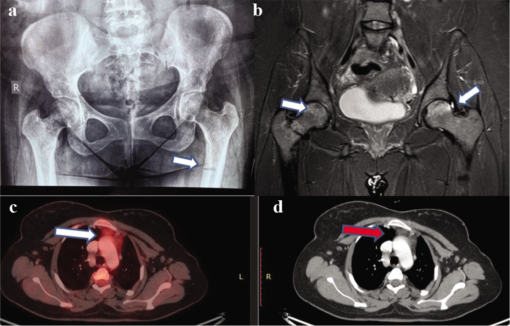 (a) X-ray hip revealing pseudofracture; (b) MRI scan showing avascular necrosis of the hip; (c) 18F-fluorodeoxyglucose positron emission tomography; and (d) CT showing increased uptake and a lesion in the thymus