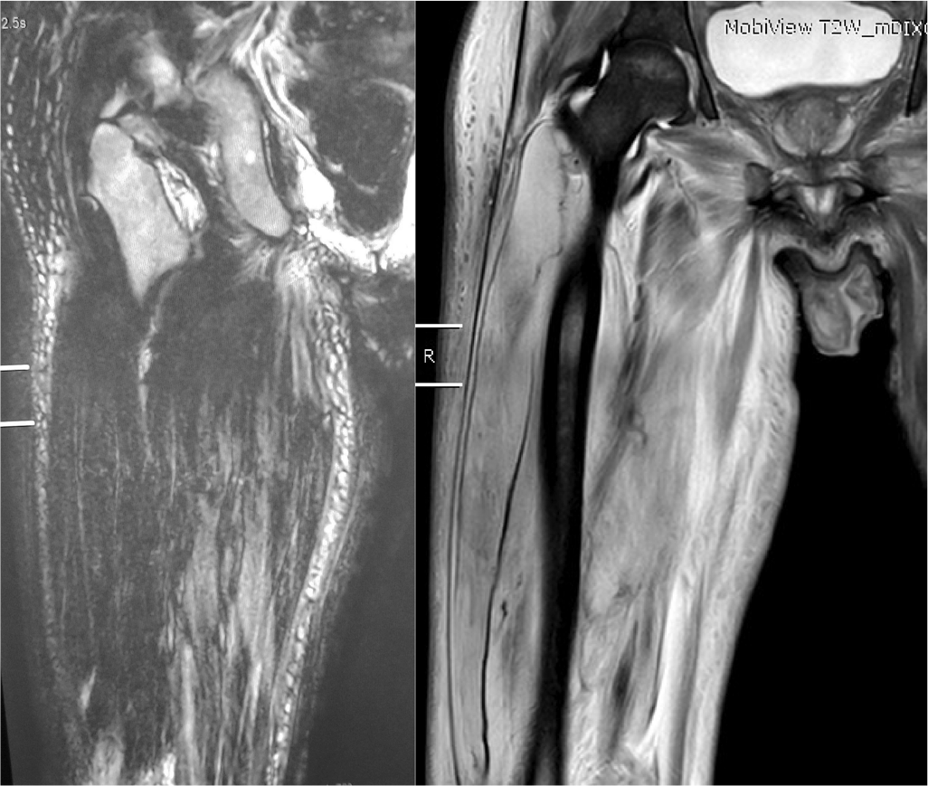 T1- and T2-weighted (left and right panel) magnetic resonance imaging showing signal changes in the anterior compartment of right thigh along with mild oedema and atrophy of rest of the muscles of the right thigh (case 2)