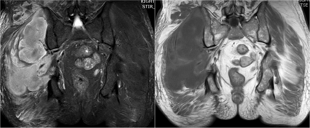 Magnetic resonance imaging showing hypointense changes in T1-weighted images (left panel) in right gluteal muscles, extensive hyperintense signal changes in short tau inversion recovery-weighted images (right panel) along with subcutaneous oedema, without any signs of intramuscular collection (case 4)