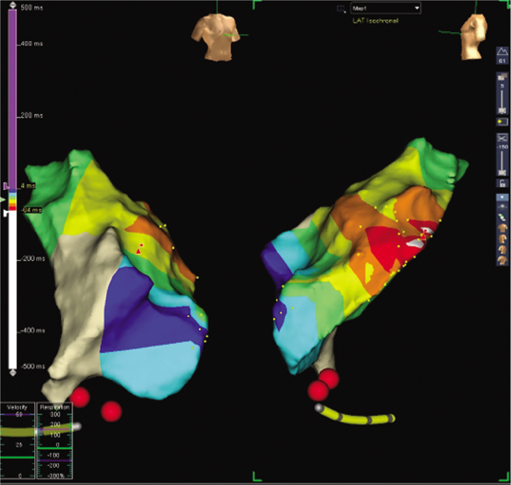 Activation mapping using three-dimensional EnSite system showing right ventricular outflow tract midseptum is earlier than surface electrocardiogram by 53 ms