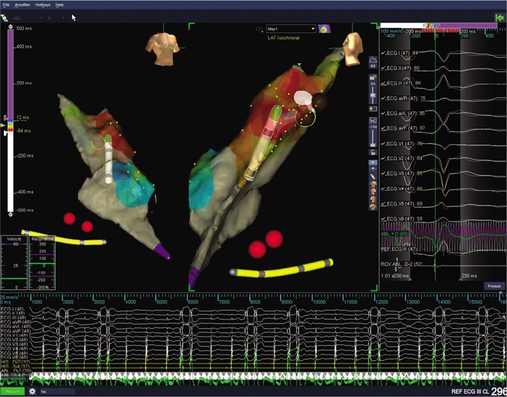 Ablation burn delivered to right ventricular outflow tract midseptum