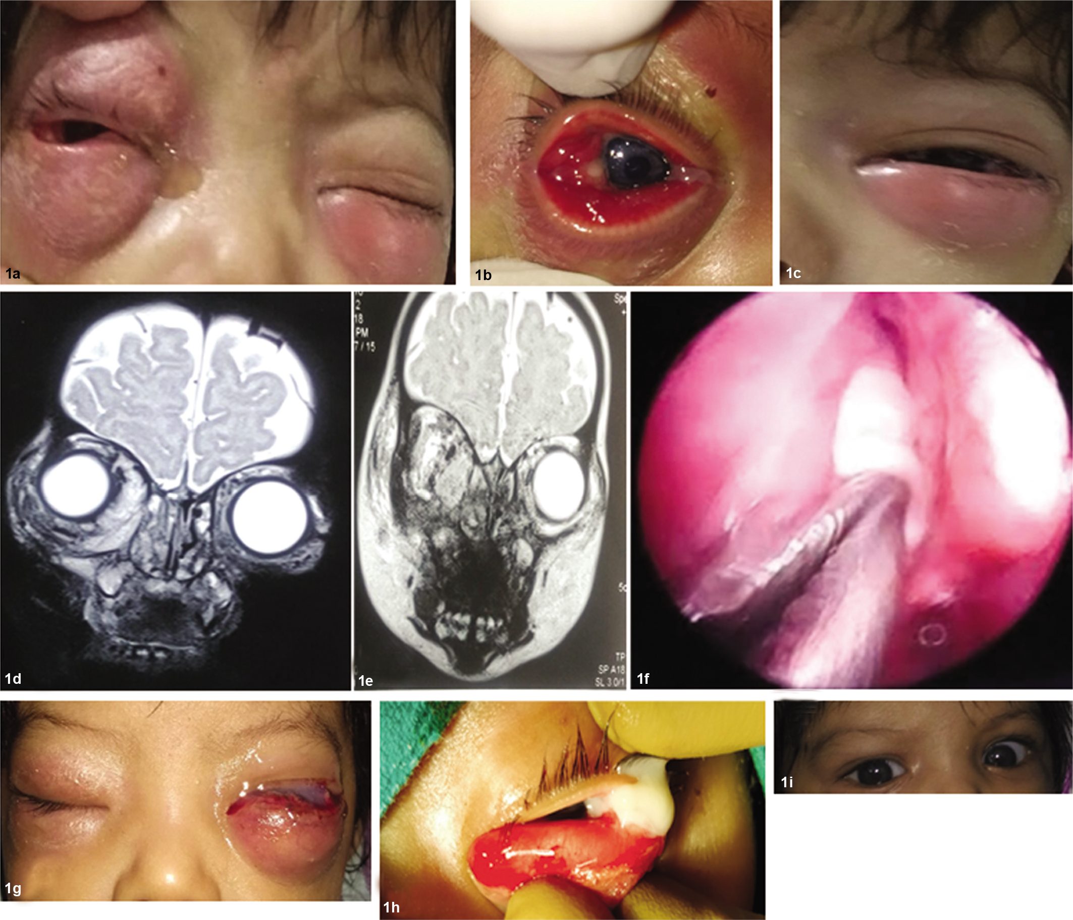 Clinical presentation of the patient with radiological imaging and intraoperative photographs. Presentation with swelling, redness and purulent discharge in the right eye (a and b) and similar complaints in the left eye (c). Magnetic resonance imaging showed both eye orbital cellulitis and right side ethmoidal sinusitis (d and e). Bilateral uncinectomy and right ethmoidal decompression performed under general anaesthesia (f). Right eyelid oedema decreased considerably, left eyelid oedema increased considerably (g). Left eye transconjunctival incision and drainage performed under general anaesthesia (h). One month following complete recovery (i)