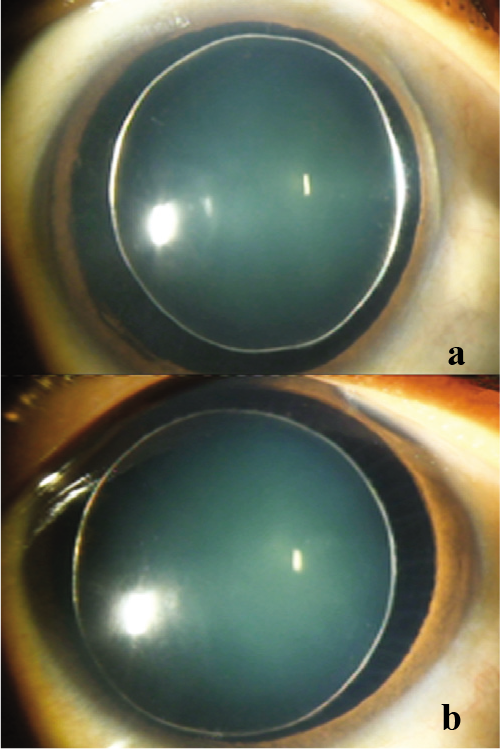 (a and b) Slit-lamp photograph of both eyes showing small-sized spherophakic lens and golden ring due to reflection of light from 360° periphery of small crystalline globular lens with stretched zonules causing anterior subluxation in the left eye