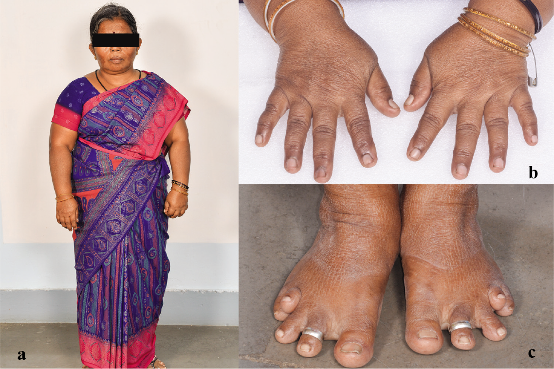 (a–c) Clinical photograph of the patient showing short stature, short fingers and toes (brachydactyly) with deformed fourth and fifth toes