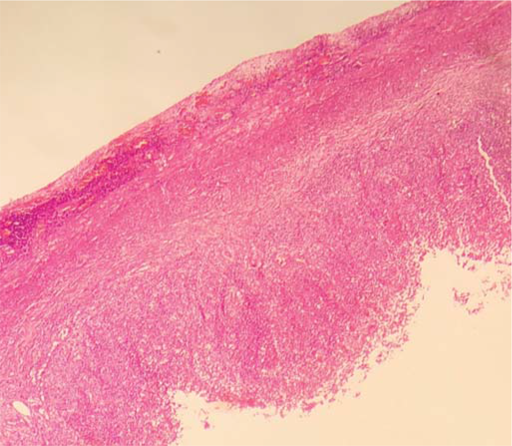 Low-power image of appendix showing absence of transmural infiltrates of neutrophils