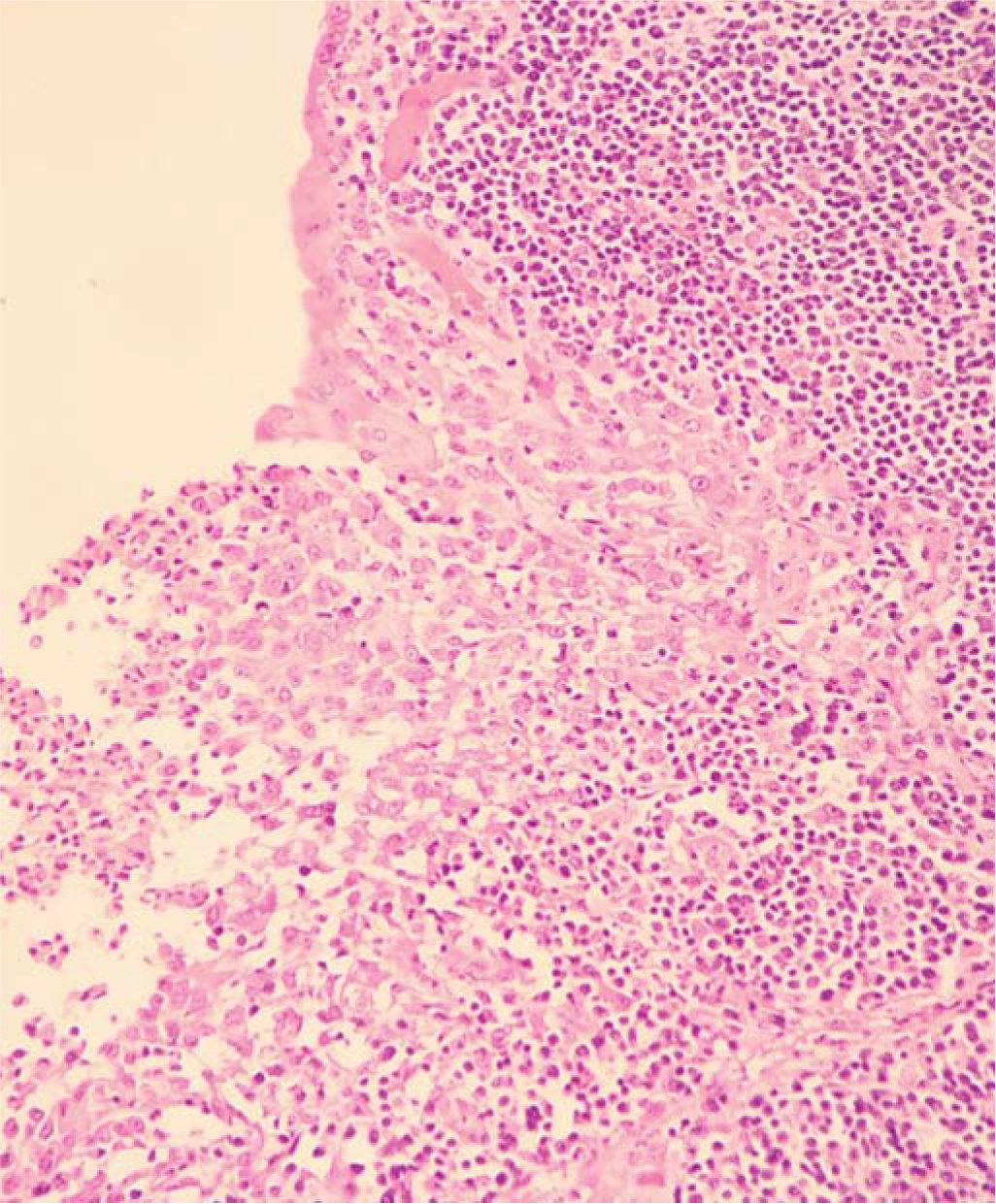 Macrophages lining the mucosal aspect of the appendix
