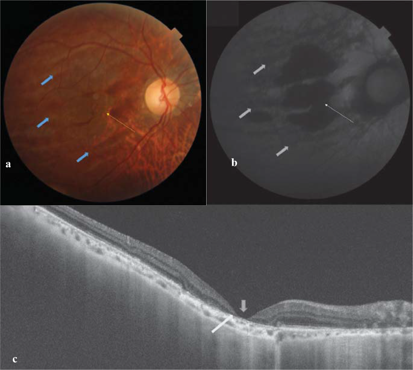 (a) Clinical photograph showing multiple linear hypopigmented streaks (blue arrow) one below the other with overlying areas of retinal atrophy (yellow arrow) at the macula; (b) fundus auto-fluorescence shows a stack of hypo-fluorescent lines with central black areas suggesting retinal pigment epithelium (RPE) and retinal atrophy; (c) Swept source optical coherence tomography (SS-OCT) showing thinning of retina (blue arrow) and loss of photoreceptors/RPE (yellow arrow) with underlying choroidal atrophy (square bracket)