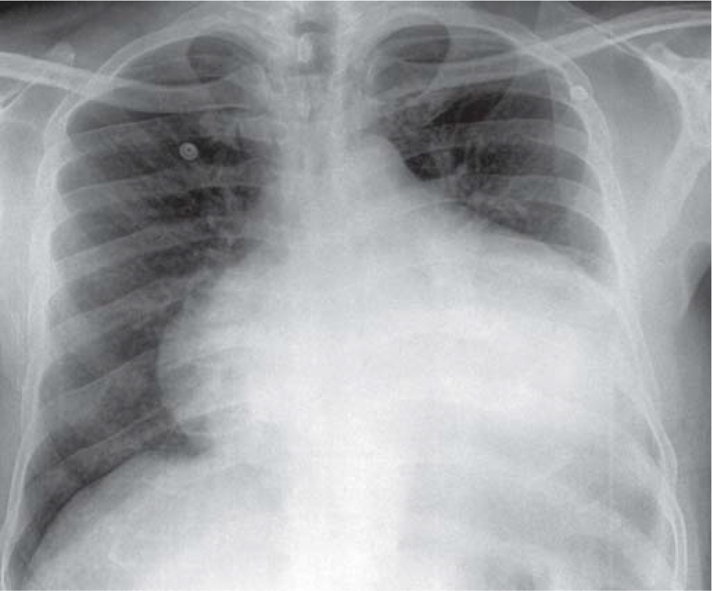 Chest X-ray showing gross cardiomegaly