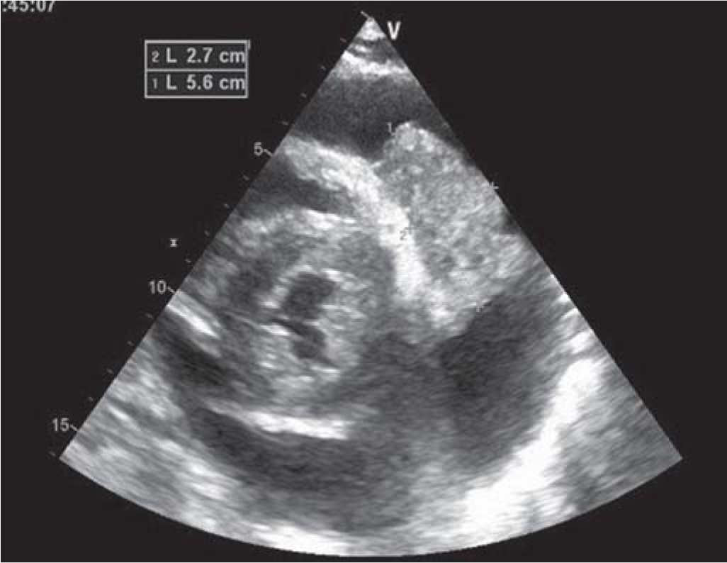 Mass in pericardial cavity