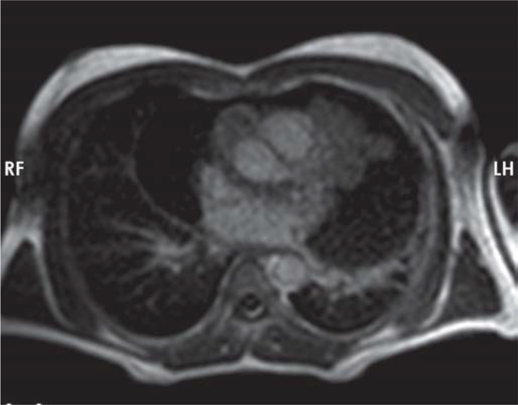 Cardiac MRI showing the mass encasing the vessels