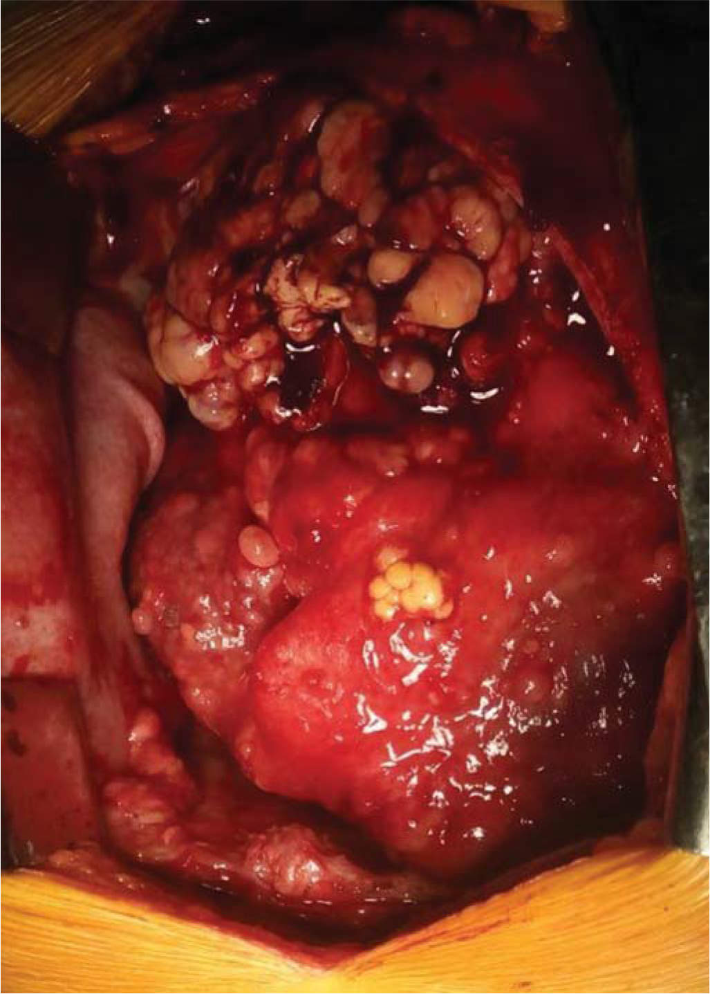 Intraoperative image of the mass within the pericardium