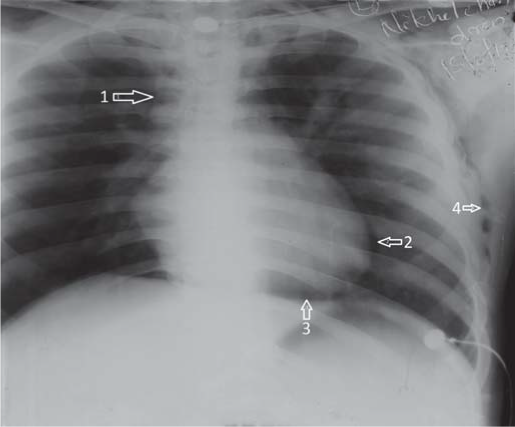 Arrow (1) Paratracheal radioluscence suggestive of pneumomediastinum; (2) pneumopericardium; (3) pneumopericardium with air space between heart and diaphragm; (4) subcutaneous emphysema