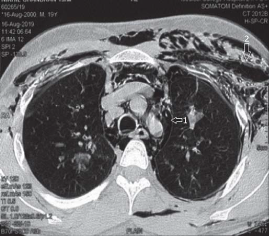 Arrow (1) pneumomediastinum; (2) subcutaneous emphysema