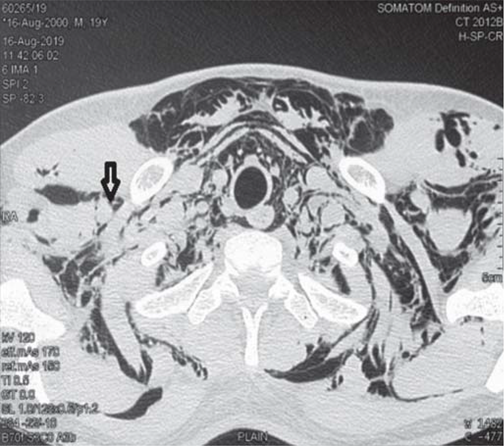 Arrow depicting air void around the axillary nerve roots suggestive of impending occurrence of epidural pneumatosis