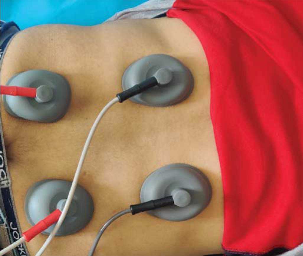 Photograph of interferential therapy (IFT) being given to a patient with low back pain