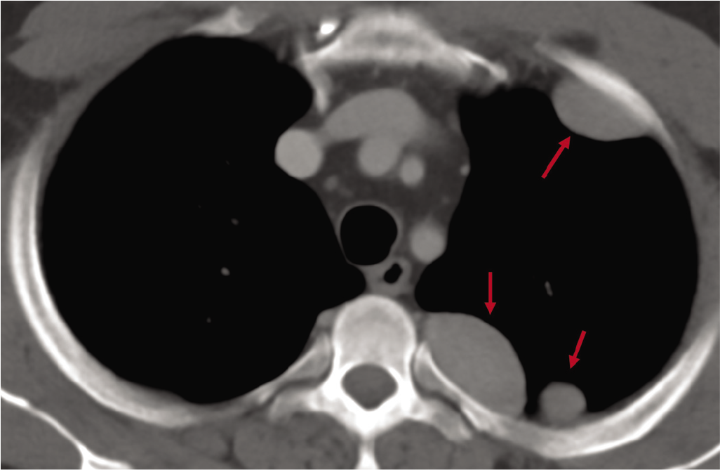 Axial computed tomography scan of the chest showing multiple pleural/extrapleural nodules (arrows)