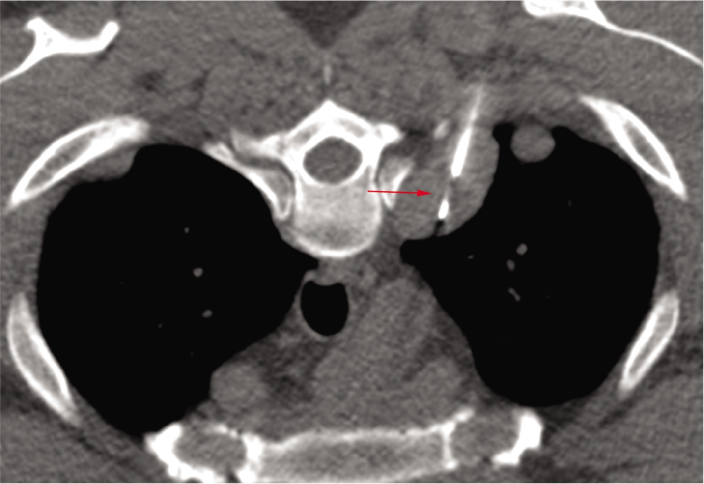 Axial prone computed tomography-guided biopsy showing the 18G gun tip inside the posterior nodule (arrow)