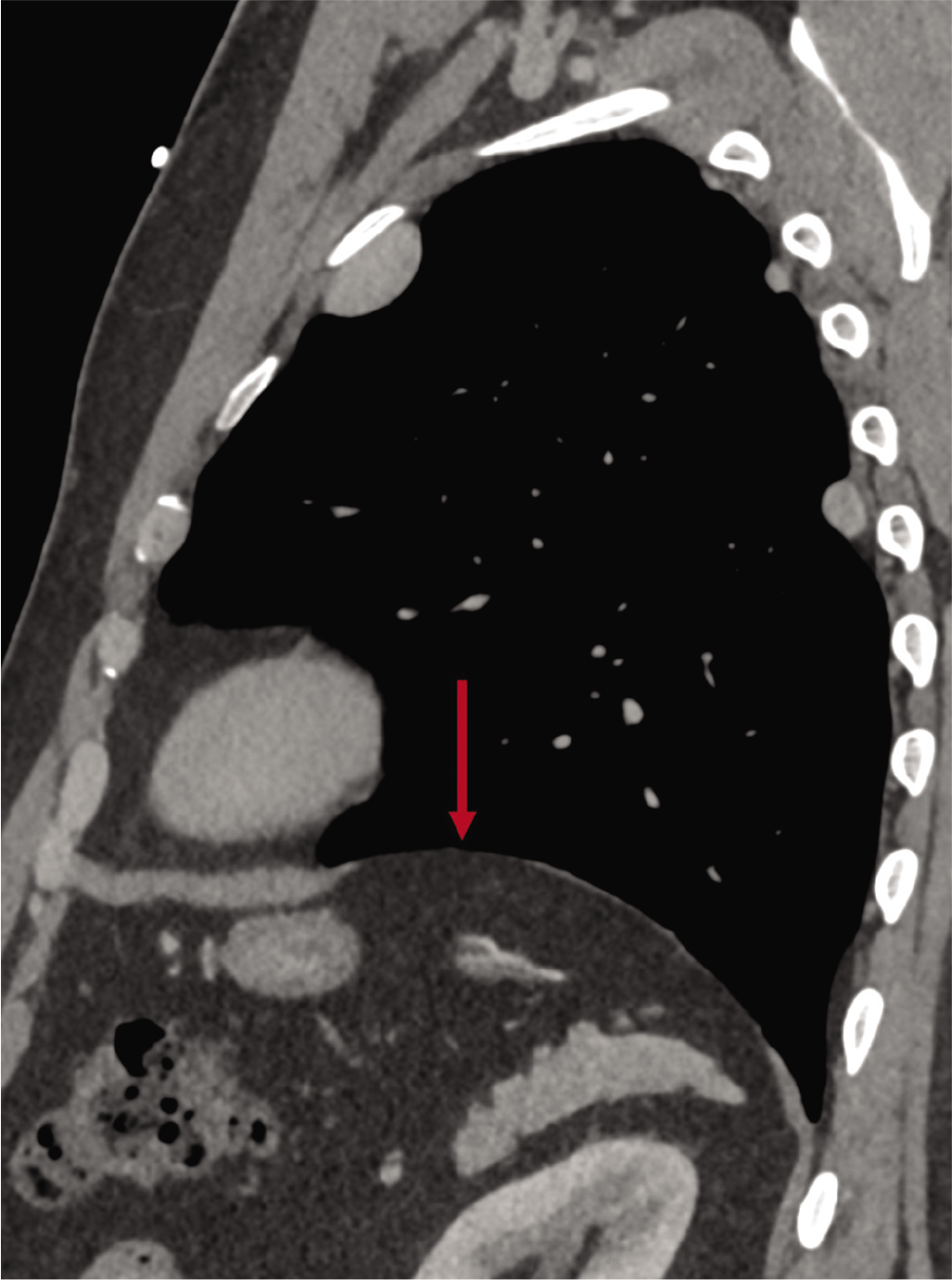 Sagittal computed tomography scan of the left half of the chest showing the defect in the left hemi-diaphragm (arrow). Note no spleen is seen