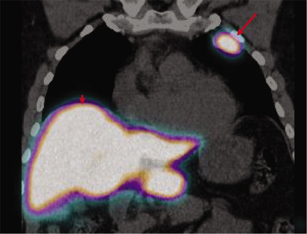 Coronal Tc-sulphur colloid scan showing the pleural/ extrapleural nodule (arrow) with the same uptake as that of the liver (arrowhead)