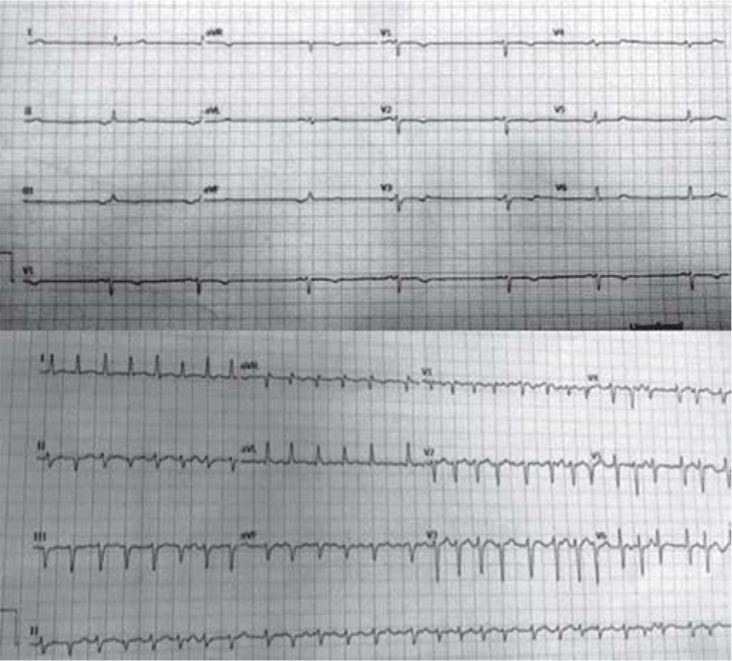 Upper panel: Electrocardiogram showing sinus arrest with low atrial escape rhythm in case 1; lower panel: Electrocardiogram showing atrial fibrillation with fast ventricular response in case 2