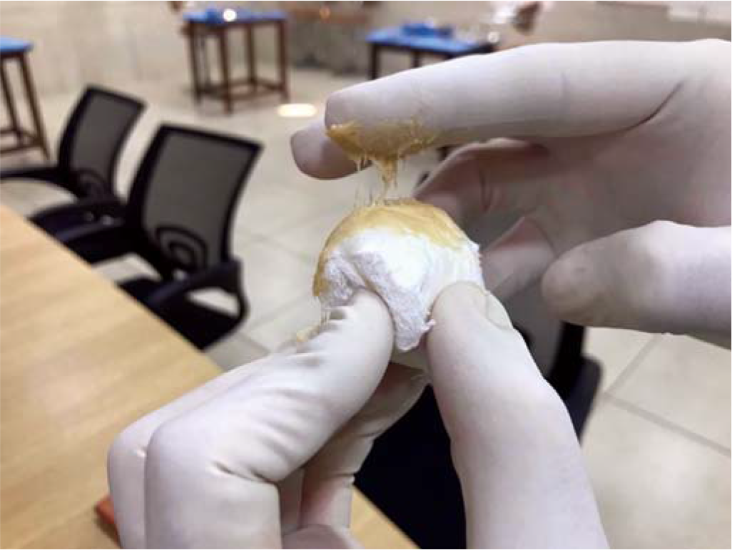 Ball made of surgical bandage to simulate lump coated with adhesive paste to mimic fibrinous and fibrous adhesions