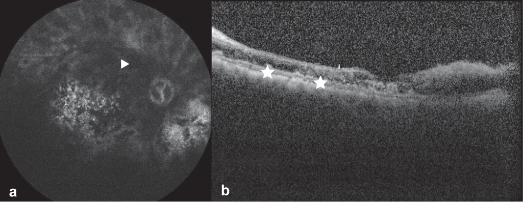 Late phase fundus fluorescein angiography (Heidelberg Spectralis) image of the right eye showing complete lack of filling of the arteries and veins diagnostic of combined vascular occlusion (arrowhead) along with staining of drusen-like deposits (a) and Spectral-Domain Optical Coherence Tomography (Heidelberg Engineering, Inc., Heidelberg, Germany) image using high definition raster scan of the right eye showing thinning and disorganization of the inner retinal layers and sub-retinal pigment epithelium deposition of drusen-like deposits (asterix) (b)