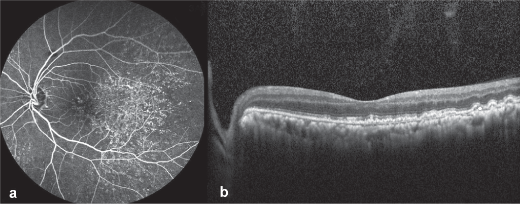 Late phase fundus fluorescein angiography (Heidelberg Spectralis) image of the left eye showing normal filling of the arteries and veins and staining of drusen-like deposits throughout the mid and late phase (a) and Spectral-Domain Optical Coherence Tomography (Heidelberg Engineering, Inc., Heidelberg, Germany) images using high definition raster scan of the left eye showing sub-retinal pigment epithelium deposition of drusen-like deposits (b)