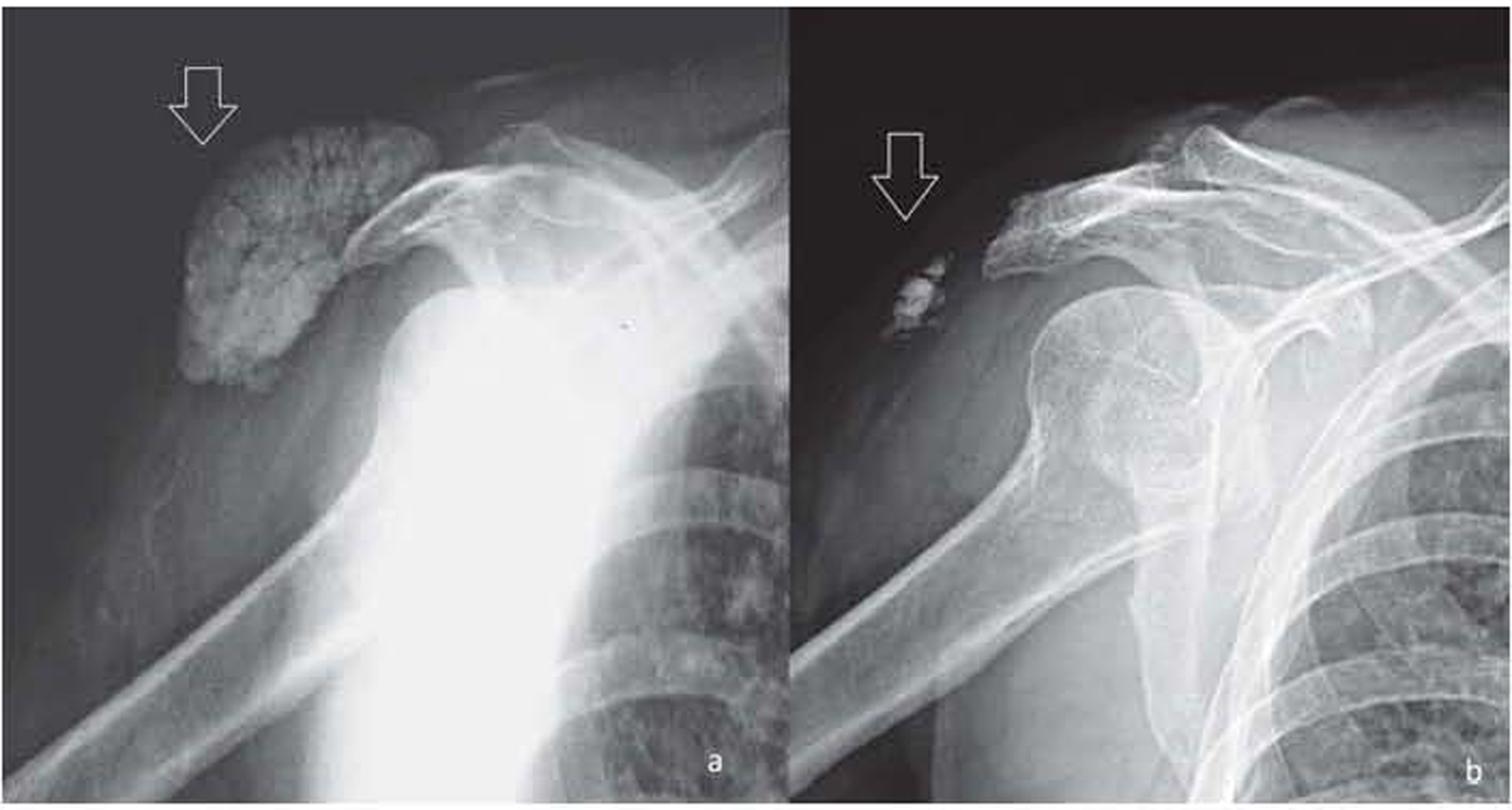 X-ray of the right shoulder joint: (a) white arrow showing massive calcium deposition, which is well-circumscribed, multilobular, periarticular without involvement of the bones; (b) residual calcium deposits after treatment