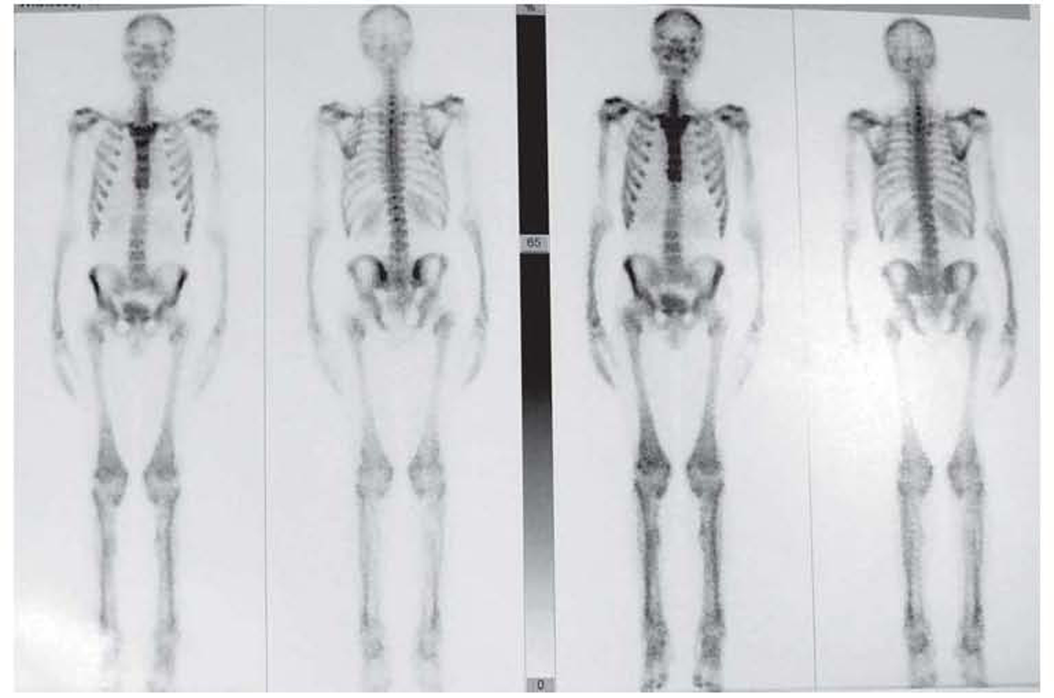 Technetium-99m bone scan showing symmetrical diffuse uptake in the long bones