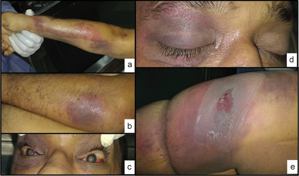 (a and b) Upper and lower limbs, trunk showing multiple ecchymotic patches; (c) bilateral subconjunctival haemorrhage; (d) periorbital haemorrhage right eye; and (e) thigh lesion with necrosed central area and surrounding erythema