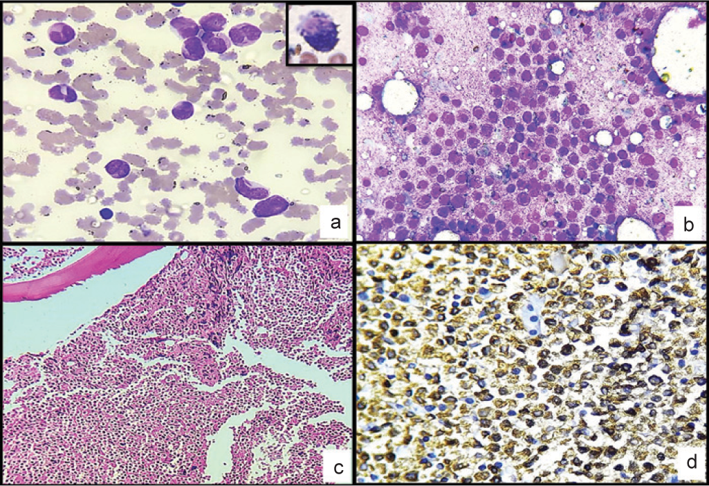 (a) Peripheral blood. (Leishman stain; ×400) showing promyelocytes with granules, Auer rods, faggots and thromboocytopenia. (a: inset) Strong positivity for myeloperoxidase; (b) bone marrow imprint smear (Leishman stain; ×400) 90% immature myeloid cells likely promyelocytes; (c) bone marrow biopsy (H and E; ×100) 95% marrow cellularity with sheets of immature, monomorphic cells. These cells have scant cytoplasm, round nuclei and inconspicuous nucleoli; (d) (myeloperoxidase; ×400) strong myeloperoxidase-positive cells