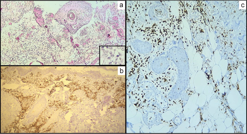 (a) (H and E; ×100) Thigh lesion showing intact skin with ulcerated area along with collection of leukaemic cells; (highlighted in inset) (b, ×100; c, ×400) (myeloperoxidase) strong myeloperoxidase positive leukaemic infiltrate in dermis (papillary and reticular) and subcutaneous tissue of the thigh