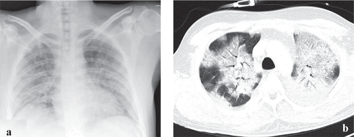 (a) Chest X-ray showing bilateral air-space opacities; (b) axial CT scan of chest showing bilateral symmetrical peribronchovascular ground glass opacities and interlobular septal thickening suggesting ARDS