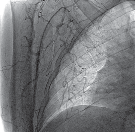 Fluoroscopic view showing extravasation of blood from the axillary artery