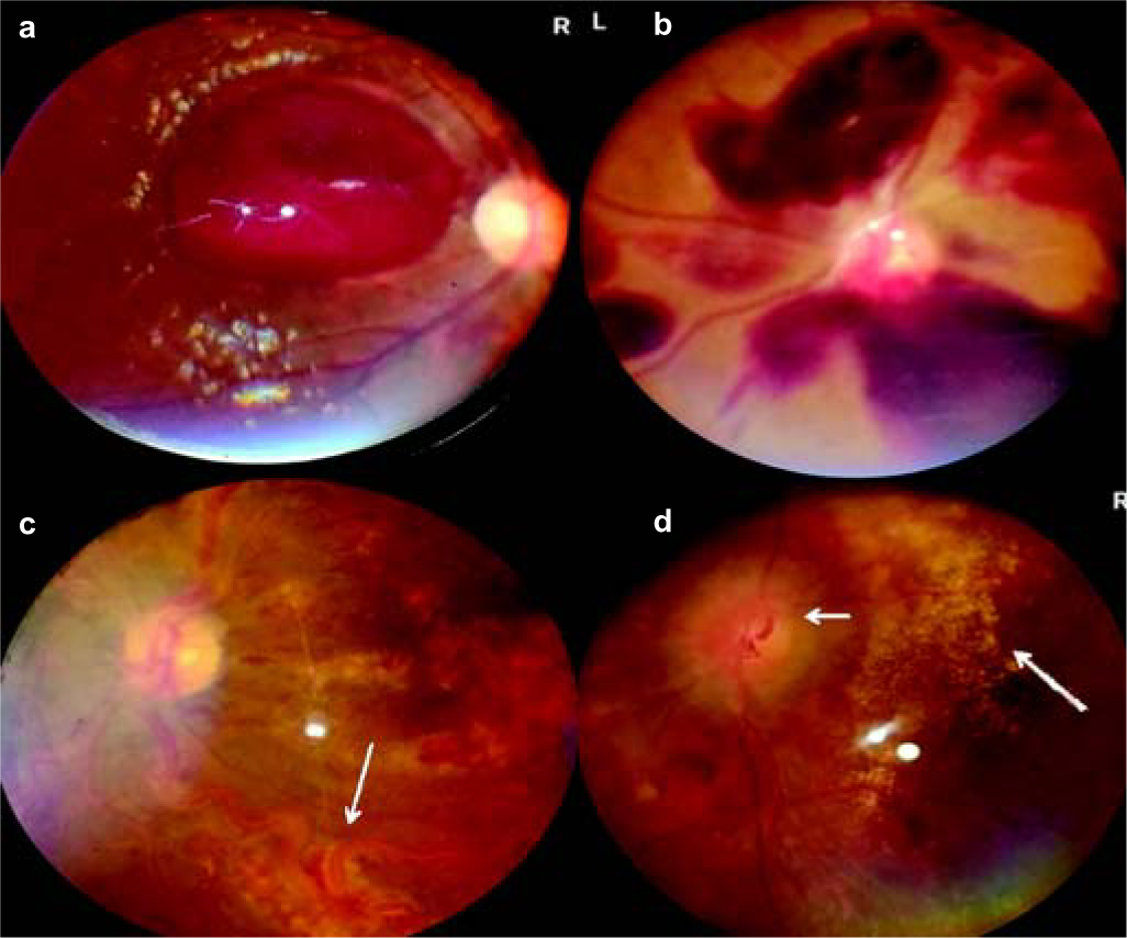 (a) Subhyaloid haemorrhage in aplastic anaemia; (b) extensive retinal bleeds in acute leukaemia; (c) frosted branch angiitis in cytomegalovirus retinitis; (d) macular star (long arrow) and papilloedema (short arrow) in malignant hypertension