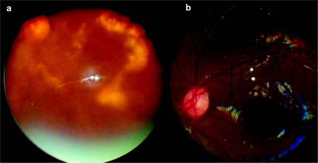 (a) Blurred picture of diabetic retinopathy, due to cataract;(b) excessive tears mimicking macular lesions