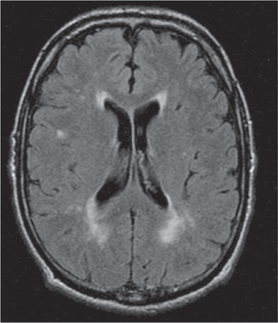 Magnetic resonance imaging of the brain showing few discrete and early confluent T2 FLAIR hyperintense white matter changes in periventricular and posterior parietal white matter